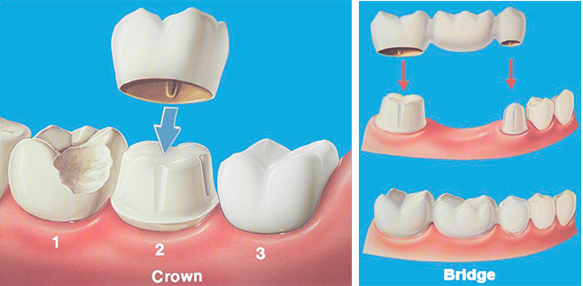 Duns Dental Crown and Bridge